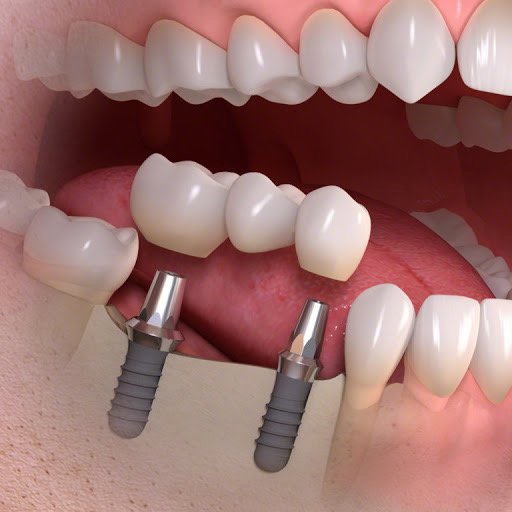 Основные особенности виды имплантации зубов
