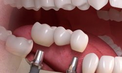 Основные особенности виды имплантации зубов